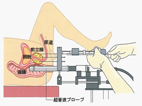 超音波ガードプライメージ